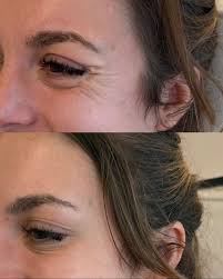 YES YES YES 👏 Smooth, natural, refreshed ✨ Anti wrinkle treatment can  gently soften frown lines, crow's feet and forehead lines, helping you look  well-rested without changing your natural expressions. Tiny tweaks,