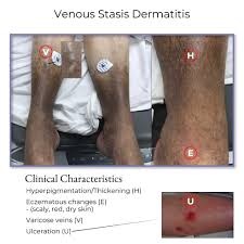 Image result for Stasis Dermatitis