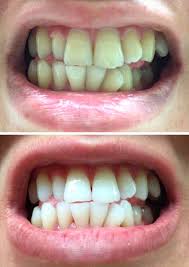 19 Teeth Whiteners That Work So Well It S Basically Magic