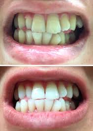 Coffee stains are easy to get out—if you attend to them early. 20 Teeth Whiteners That Work So Well It S Like Magic