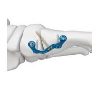 MT First MTC Plantar Fusion Locking Plate,Medical Device ...