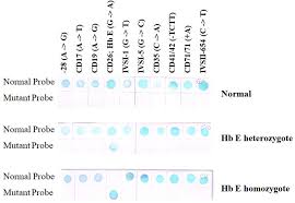 Depending on the type of beta thalassemia, symptoms can be mild or very severe. Frontiers Update In Laboratory Diagnosis Of Thalassemia Molecular Biosciences