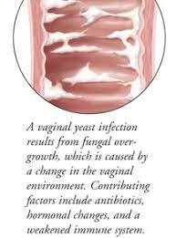 These sores may appear anywhere. Vaginal Yeast Infection