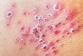 Herpes virus infection can cause the symptoms of hiv rash to worsen especially in individuals at the advanced stage of hiv. Viral Skin Conditions Pictures Of Rashes Blisters And Sores In Adults And Toddlers