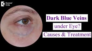 You could also buy eye serums and concealers for under your eye. Veins Under Eyes Dark Blue Veins Under Eye Causes Treatment Dr Nischal K Doctors Circle Youtube