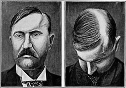 Parry–Romberg syndrome