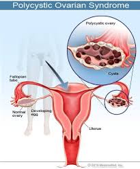 Pcos is caused by immature follicles which grow on the ovaries and subsequently cause an imbalance of hormones. What Are Polycystic Ovarian Syndrome Pcos Symptoms Diagnosis