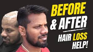 Before & After a Non-Surgical Hair Replacement System for Men/Women (Hair  Loss/Baldness) UK/USA