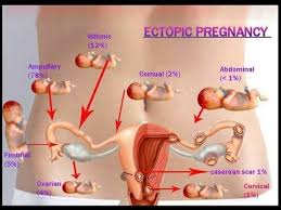 Ectopic Pregnancy Youtube
