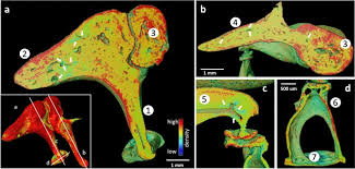 Image result for Ossicular Chain Disruption
