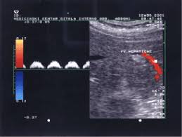 Wondering what color represents a particular cause? Improved Detection Of Metastases By Color Doppler Ultrasonography