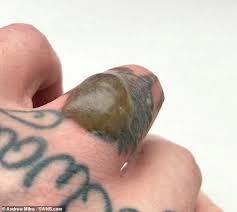 There are currently 105 tattoo removal + blister questions and doctor answers on realself. Laser Tattoo Removal Leaves Hapless Divorcee With A Grotesque Brown Blister Express Digest