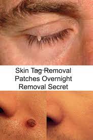 Skin Tag Removal Patches Best Skin Tags Removal Skin Tag Removal Skin Tag On Eyelid Skin Tags On Face