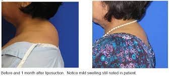 Do you have one of these? Treating Dorsal Cervical Fat Or The Buffalo Hump Aesthetic Laser Center
