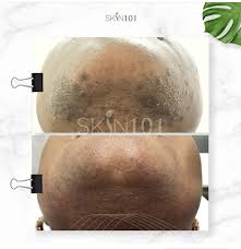 Electrolysis is a cosmetic procedure for removing unwanted hair. Laser Hair Removal Vs Electrolysis Which Is Better