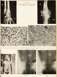 Image result for Venous Hum