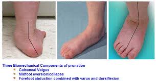Low Muscle Tone Pronation Developmental Delays Low Muscle Tone Occupational Therapy Kids Pediatric Physical Therapy