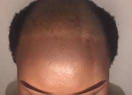Most often, cradle cap resolves itself, which could be anywhere from six months to a year. African Women On The Shame Of Hair Loss Bbc News