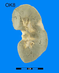 Image result for Renal Infarction