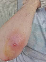 Heart palpitations (heart skips a beat or seems to flutter) low energy (more in children) irritability (more in children) Julian Burnside A Twitter How We Treat Refugees On Manus Blood Poisoning It Started As A Swollen Tongue But Now Https T Co Cy946al22j