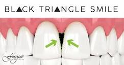 Why Do I Have Black Triangles in My Teeth | Jonesboro, AR