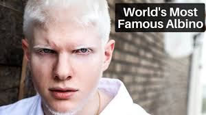 Tıp literatüründe albinizm halk dilinde bilinen adıyla albino, dünya genelinde önemli ölçüde değişiklik göstermekle birlikte yaklaşık 17.000 doğumda görülüyor. Drew Binsky World S Most Famous Albino Facebook