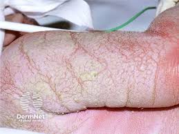 Image result for Ichthyosis