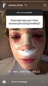 Facetouchup is the premier tool for visualizing plastic surgery results. Naomie Olindo S Nose Job See Post Op Photo From Rhinoplasty Surgery Style Living