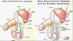 Pin On Vasectomies