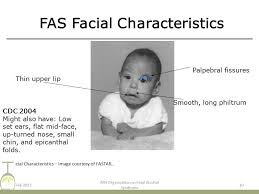 Epicanthal folds are considered a diagnostic parameter for fetal alcohol syndrome. Working With Kids With Fetal Alcohol Spectrum Disorders Fasd Ppt Download