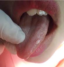 Image result for papillomavirus tongue)