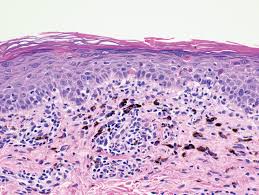 Image result for Photodermatitis