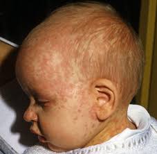 Nach der ersten impfung bilden etwa 90 von 100 menschen schützende antikörper. Bvkj Masernimpfungen Sind Ab 11 Lebensmonat Moglich Welt