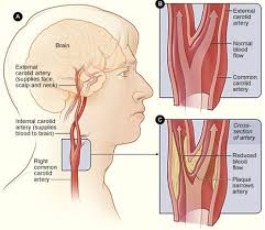 We did not find results for: Carotid Artery Disease Pacific Stroke Neurovascular Center