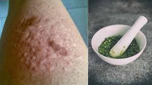 Obat Eksim Herbal Alami Paling Ampuh Bisa Dibuat Sendiri Di Rumah