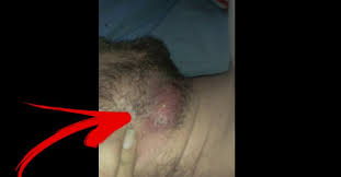 This is a natural bartholin cyst home treatment that works! Popping Giant Cyst