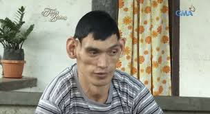 Derita Gigantisme, Pria Ini Tingginya Mencapai 2,2 Meter, Begini Ia  Diperlakukan Masyarakat