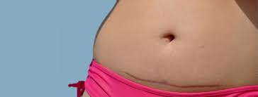 When Can You Have A Tummy Tuck After C Section Tummy Tuck After C Section Tummy Tucks Tummy Tuck Procedure Abdominoplasty