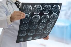 A Small Chip Under The Skin May Predict Second Stroke Harvard Gazette