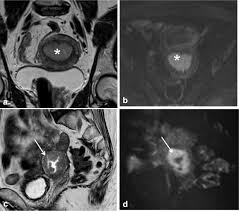 Endometriosis is defined as the presence of endometrial tissue outside the uterine cavity. Prediction Of Histological Grade Of Endometrial Cancer By Means Of Mri European Journal Of Radiology