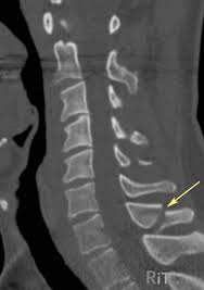There are two transverse processes that extend off each vertebra in the spine, one on each side. Clay Shoveler Fracture Cervical Spinous Process Fractures Spine Orthobullets