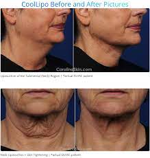The Non Surgical Neck Lift We All Want For Christmas Scoop