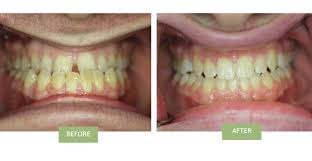 According to fritsch, using braces allows orthodontists to correct an underbite by either expanding the upper jaw (maxilla) or. Invisalign For Underbite Can Invisalign Fix Underbite
