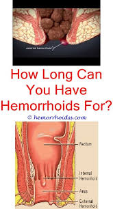 How Long Hemorrhoids Last Hemorrhoid Remedies Hemorrhoids Bleeding Hemorrhoids