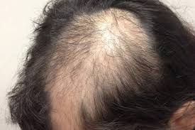 This is generally recognizable as male pattern baldness, or medically known. Derm Dx Hair Loss In A Young Girl Clinical Advisor