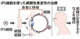 It was designed to solve the main limitations of the twisted nematic field effect (tn). Ipsç´°èƒžã‹ã‚‰ä½œã£ãŸç¶²è†œç¥žçµŒç´°èƒž é›£ç—…æ‚£è€…ã«ä¸–ç•Œåˆç§»æ¤ ç¥žæˆ¸ã‚¢ã‚¤ã‚»ãƒ³ã‚¿ãƒ¼ç—…é™¢ æ¯Žæ—¥æ–°èž