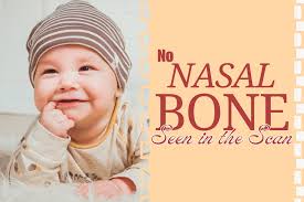 No Nasal Bone Seen in the Scan: Does It Mean the Baby Does Not Have a Nose?