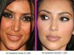 Matthew Shannon On Twitter Kardashian Plastic Surgery Plastic Surgery Photos Celebrity Plastic Surgery