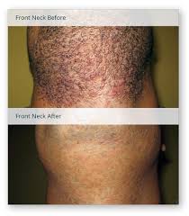 laser hair removal for folliculitis