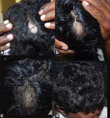 Is there a relationship between homocysteine and vitiligo? Indian Journal Of Dermatology Venereology And Leprology Alopecia Areata Vitiligo Overlap Syndrome An Emerging Clinical Variant